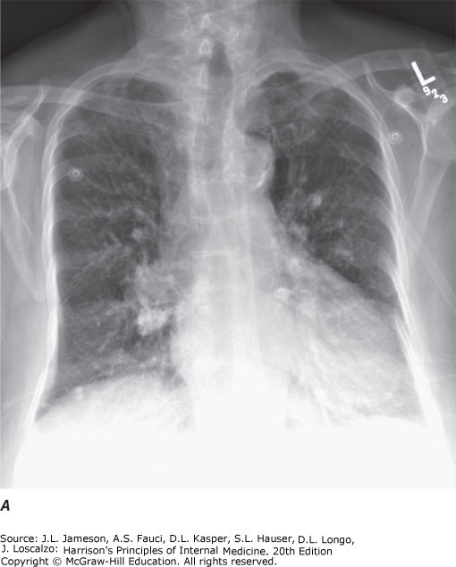 Chest X-ray and CT showing right lower lobe mass