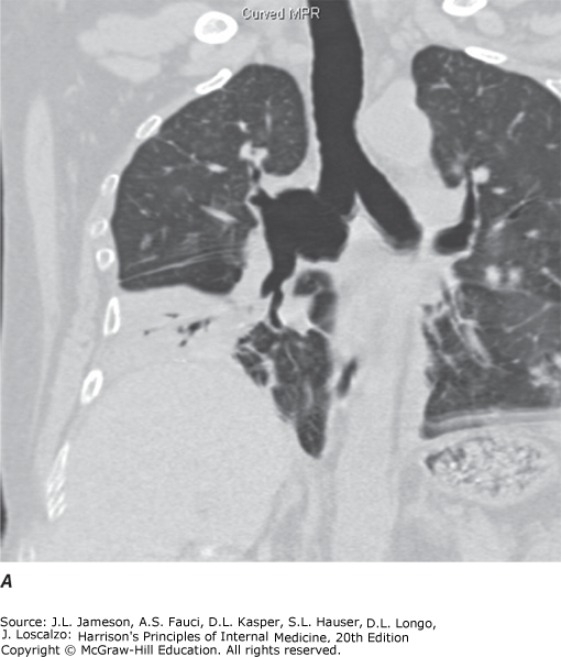 Spiral CT with sagittal reconstruction showing bronchial anastomosis