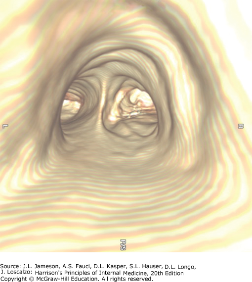 Virtual bronchoscopic image of trachea showing carina and main stem airways