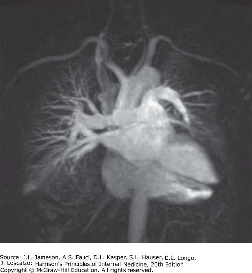 MR angiography of lung transplant vasculature
