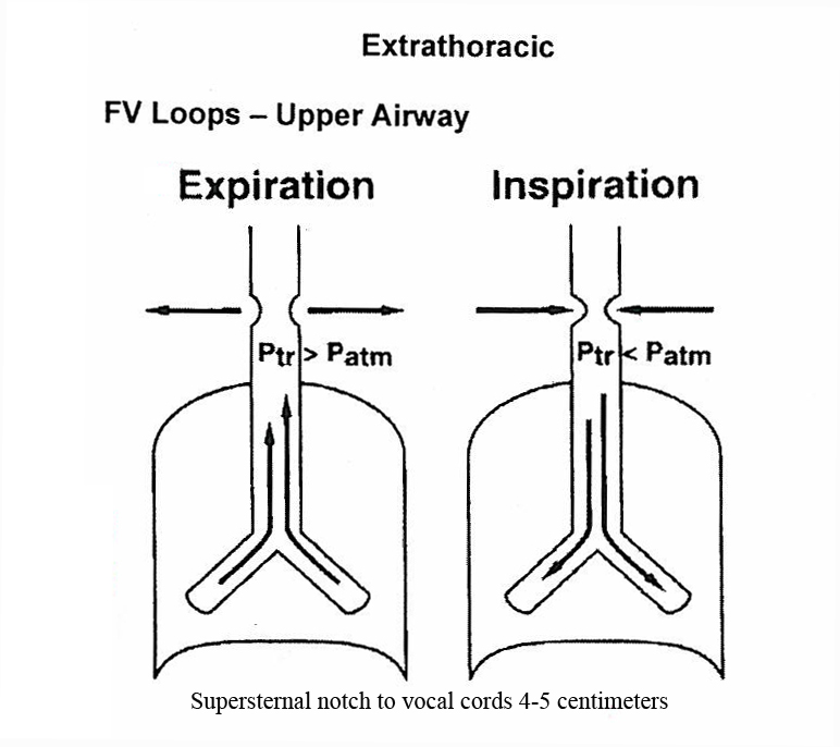 Extrathoracic upper airway obstruction flow-volume loop showing inspiratory flattening