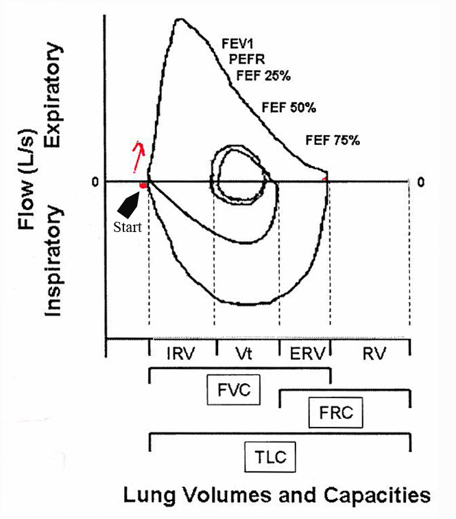 Normal flow-volume loop with lung volumes labeled showing FEV1, PEFR, FEF points, and relationship to IRV, Vt, ERV, RV