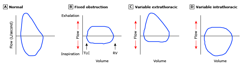 Four flow-volume loop patterns: A) Normal B) Fixed obstruction C) Variable extrathoracic D) Variable intrathoracic