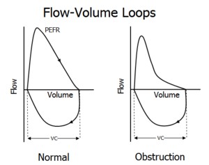 Flow-volume loops comparing obstructive and restrictive patterns